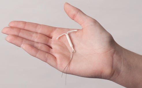 Hormonal IUD